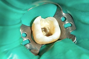 ラバーダムを使用した感染対策